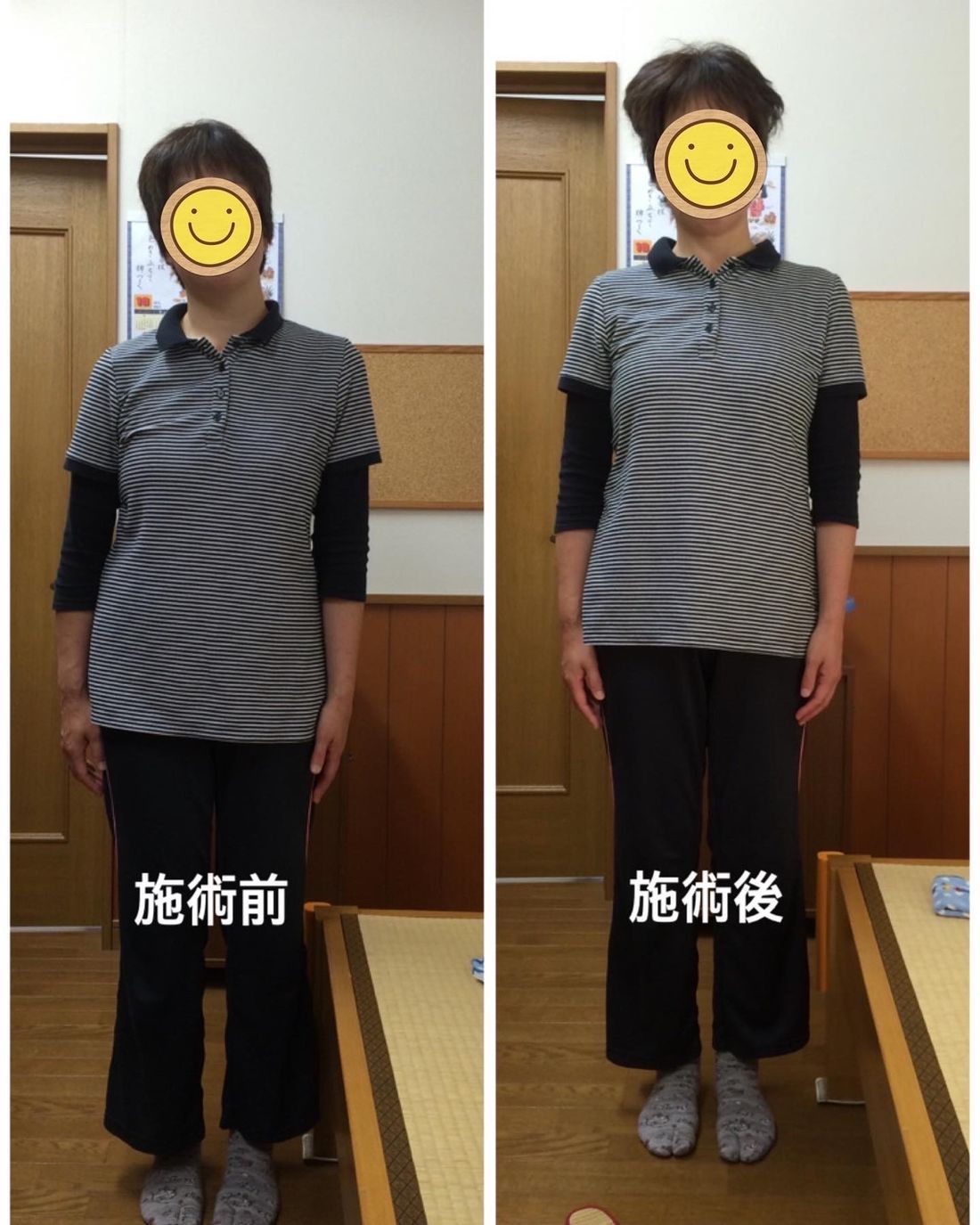 施術前と施術後の背中・首まわりの比較写真