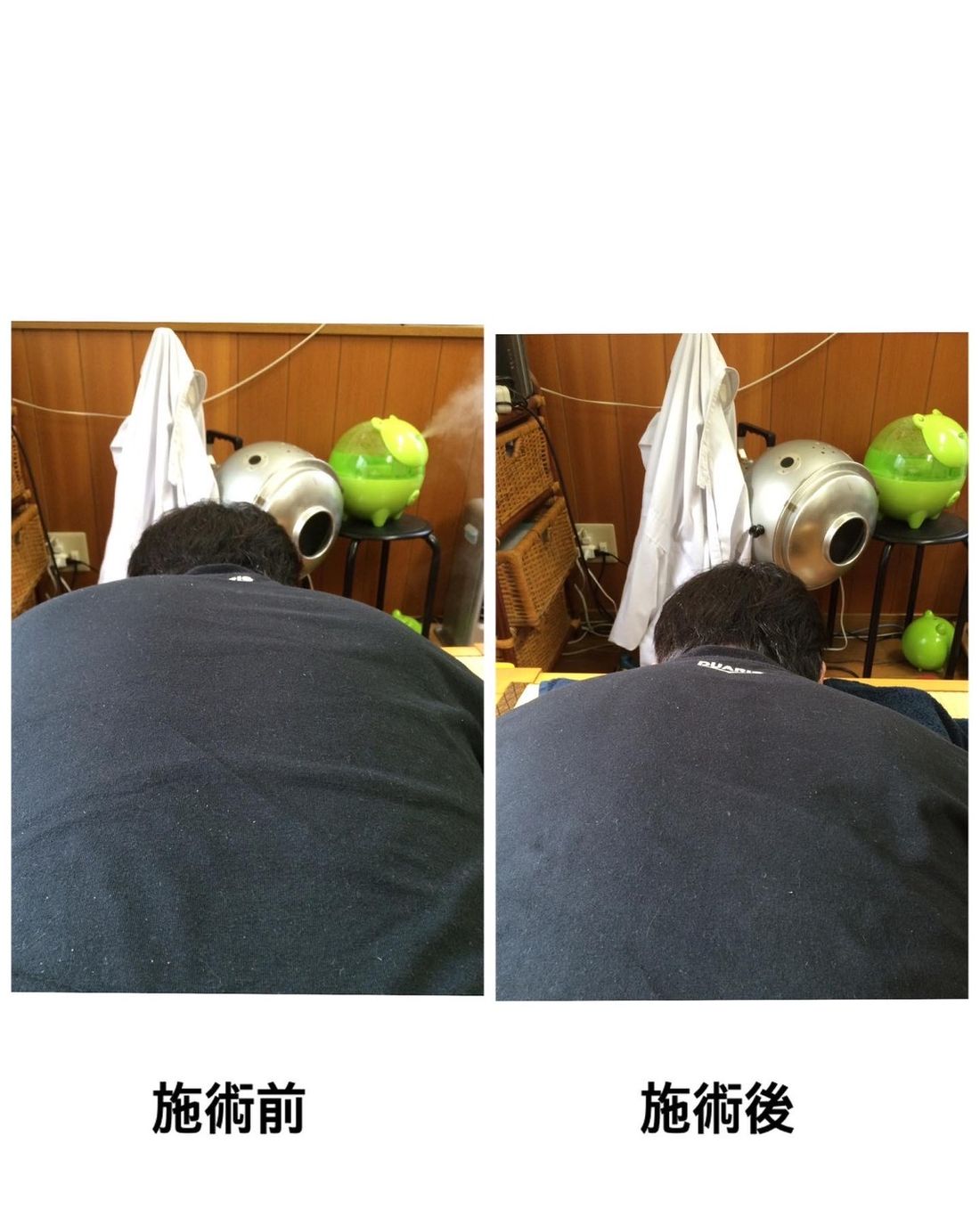 施術前と施術後の立ち姿勢の比較写真